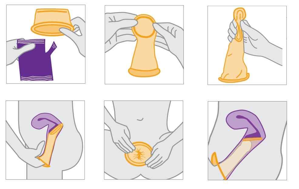 Internal Condom diagram 
